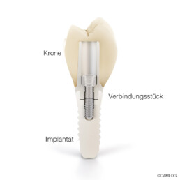 Aufbau eines Implantats anhand einer Grafik, erklärt von Dr. Stephan Girthofer in München