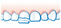Milchzahnunfall - Zahn ist abgebrochen