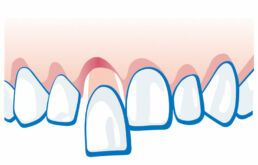 Zahnunfall - Zahn ist locker oder verschoben