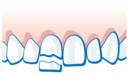 Zahnunfall -Zahnkrone oder Teilstück ist abgebrochen